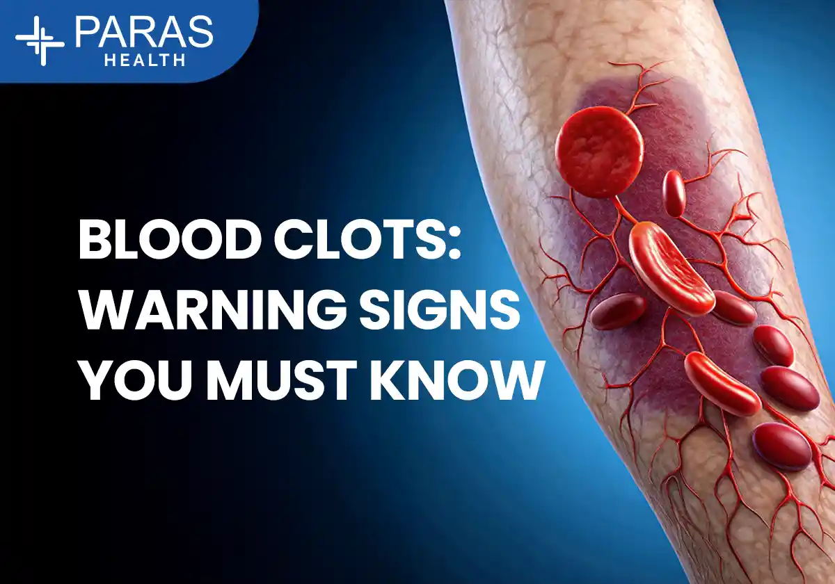 Blood Clots
